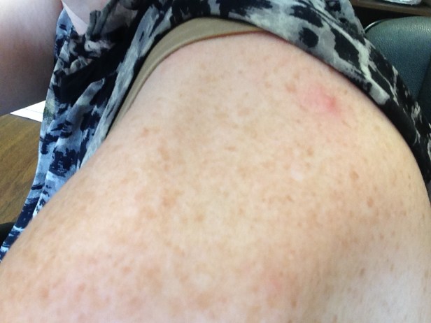 Basal Cell Carcinoma